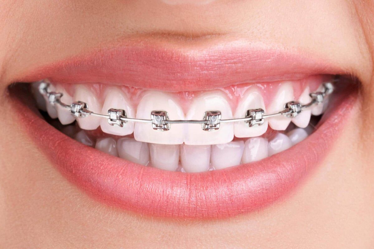 Какие брекеты можно установить в стоматологии?