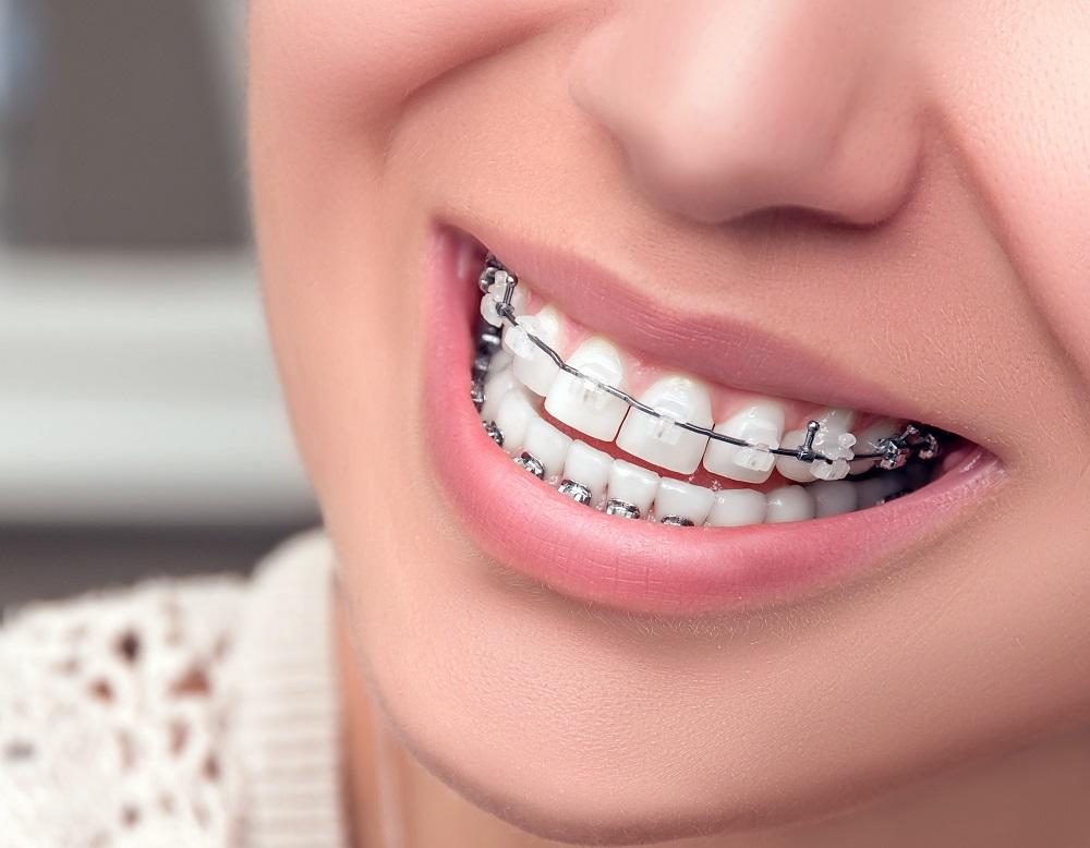 Какие брекеты можно установить в стоматологии?