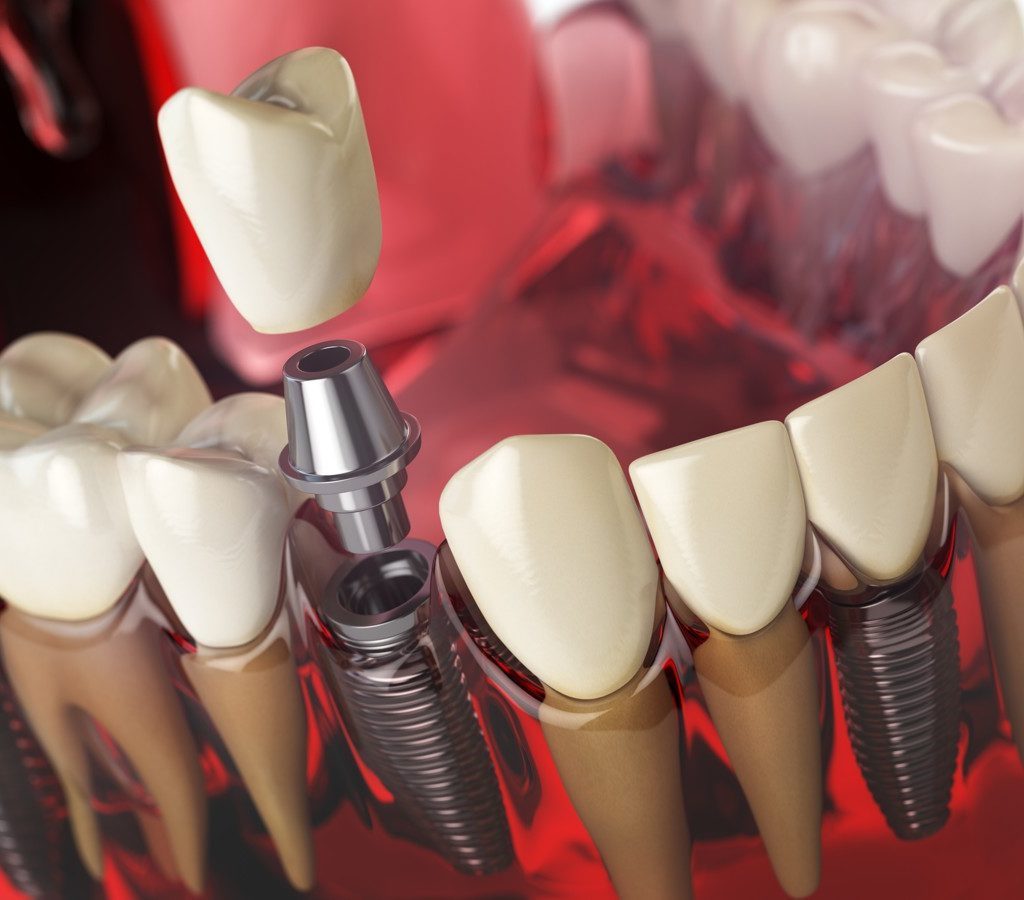 Какие функции выполняют импланты зубов?