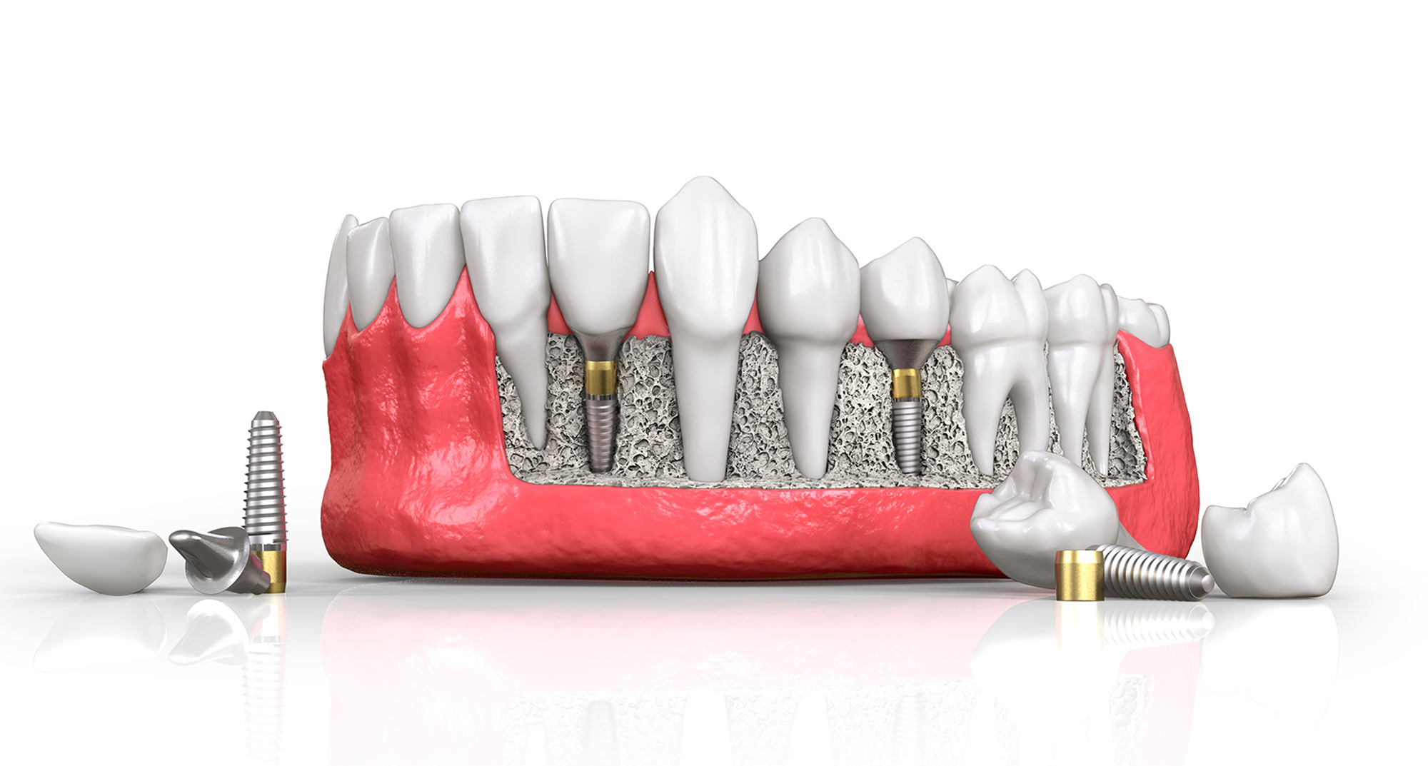Имплантацию зубов стоит доверить клинике «Reunion»
