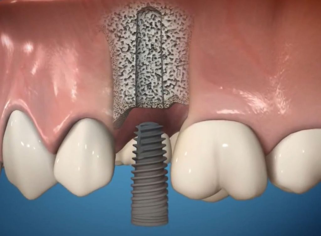 Какие функции выполняют импланты зубов?